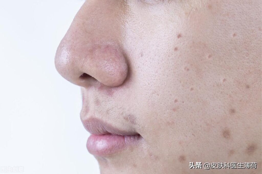 如何去痘印_去痘印的正确方法