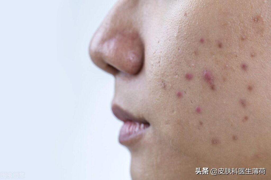 如何去痘印_去痘印的正确方法