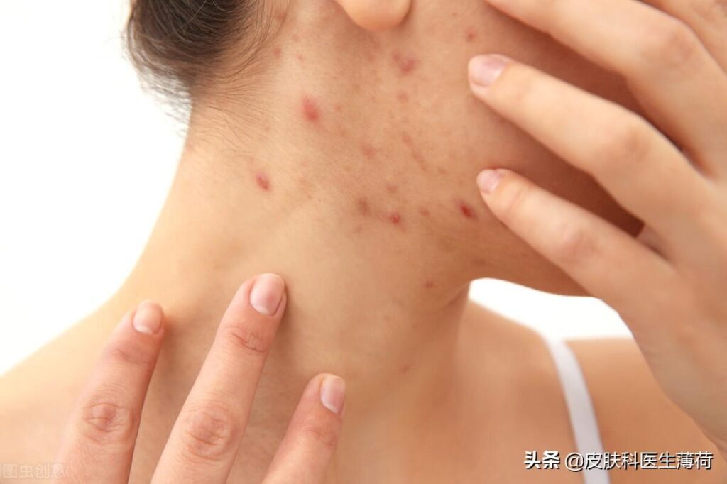 如何去痘印_去痘印的正确方法