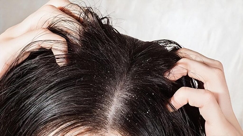 头发为什么容易油腻_头发油腻的改善方法