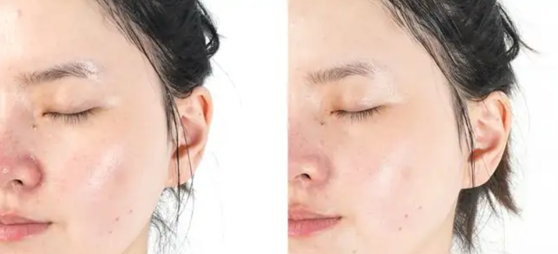 皮肤干为什么还出油_皮肤外油内干怎么改善