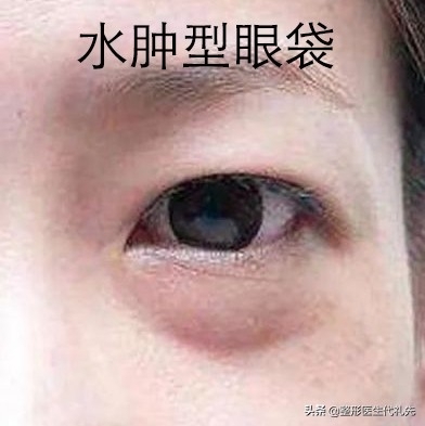 眼袋能自然消除吗，有了眼袋还能消除吗
