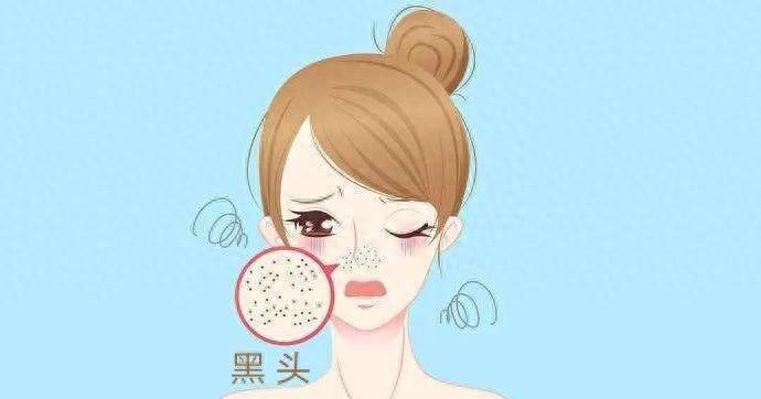 黑头是什么东西，黑头形成的过程