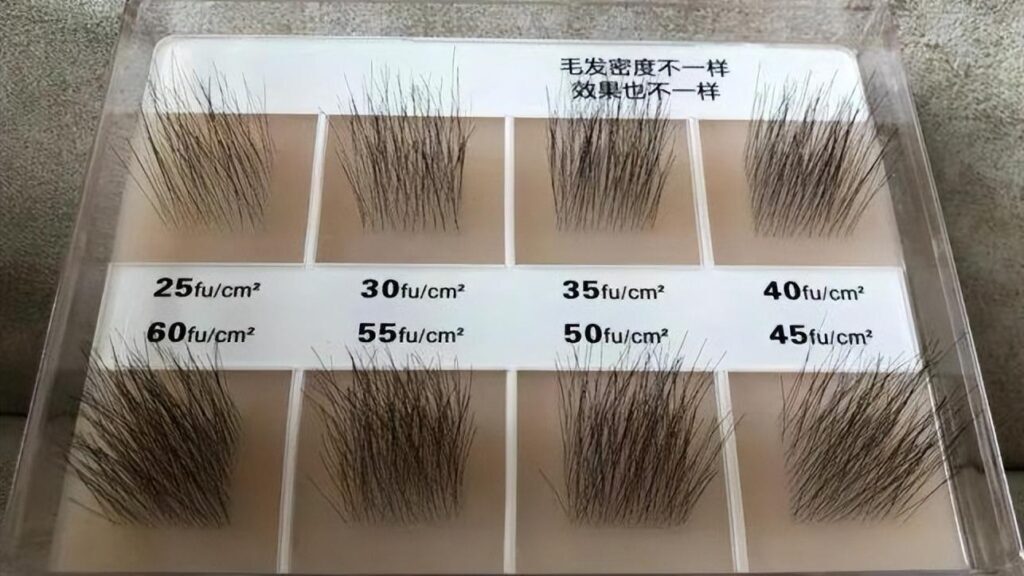 一般做个发际线多少钱？头发种植术植发一般价格