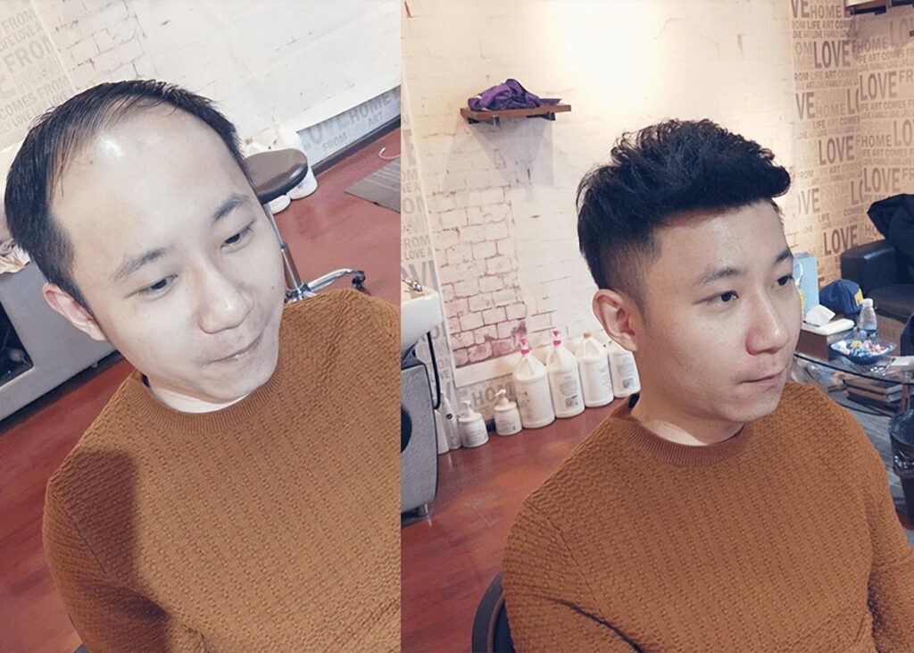 一般做发际线多少钱？做发际线有效果吗？