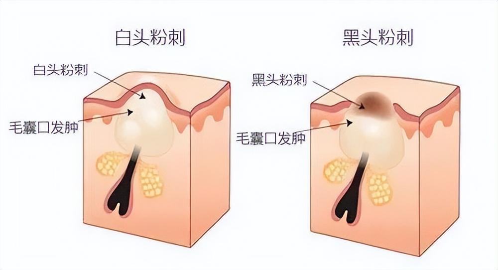 怎么消除白头粉刺?去白头粉刺小窍门