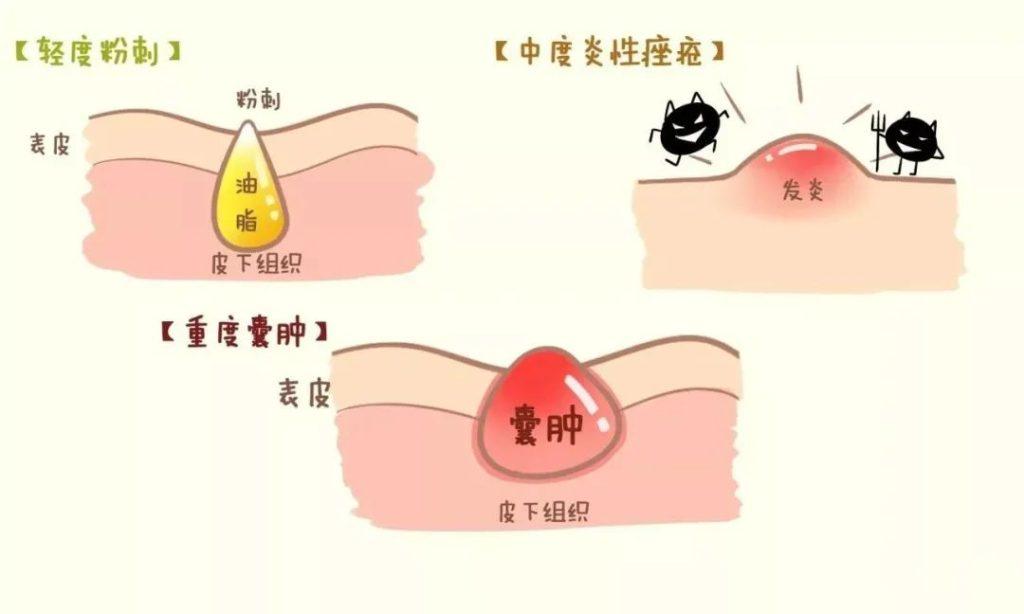 怎么消除白头粉刺?去白头粉刺小窍门