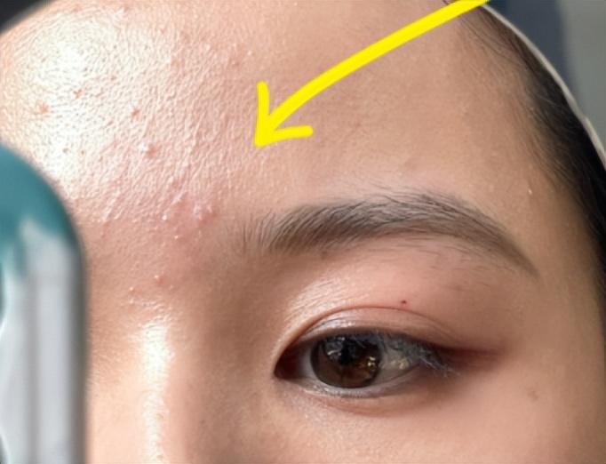 怎么消除白头粉刺?去白头粉刺小窍门